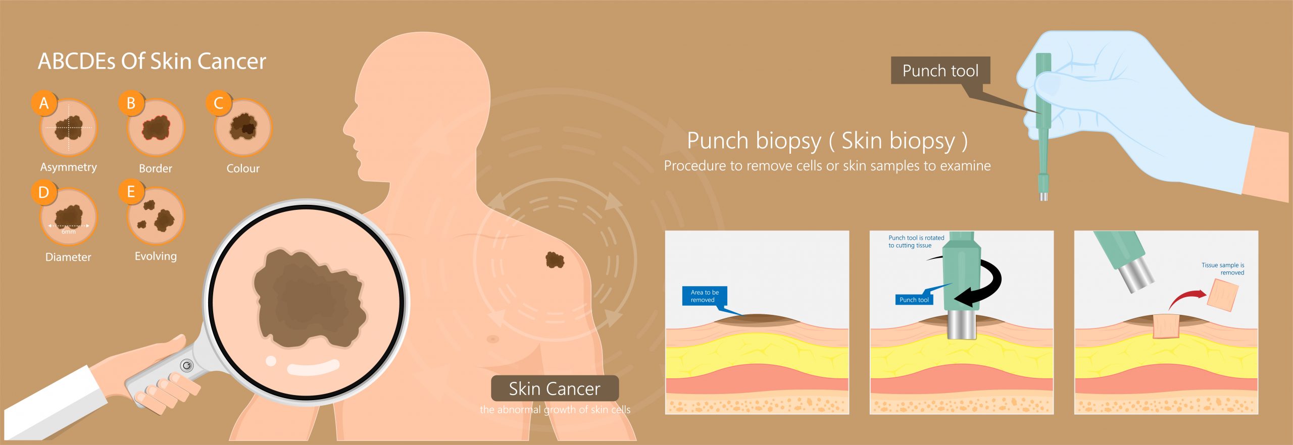 SKIN LESIONS/CANCER REMOVAL