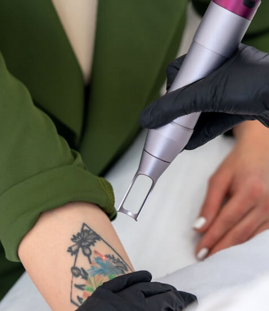 Tattoo Removal with the PicoWay Laser  Reveal Aesthetic